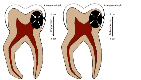 Barodontalgia – Painevaihteluiden ­aiheuttama hammaskipu